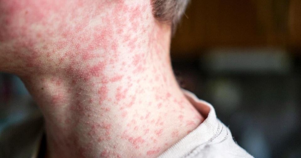 Texas Measles Outbreak Worsens Due to Vaccine Exemptions-thumbnail