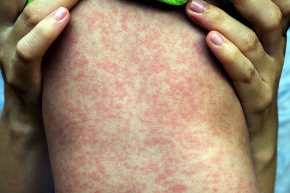 Texas Measles Outbreak Worsens Due to Vaccine Exemptions-thumbnail