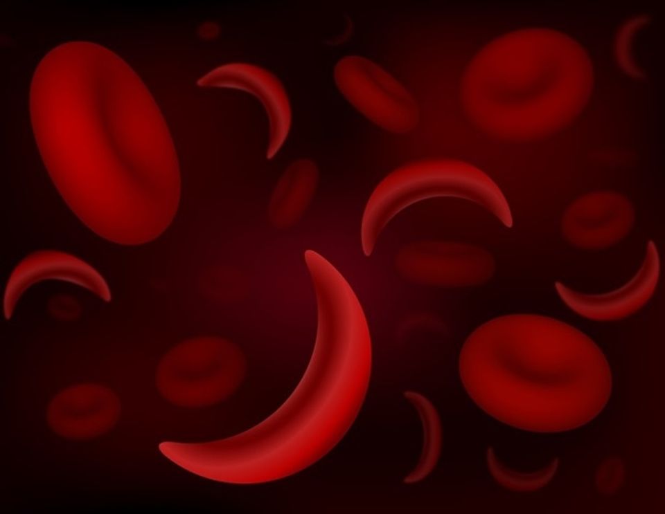 Swift transfer from pediatric to adult care may reduce hospitalization in sickle cell disease-thumbnail